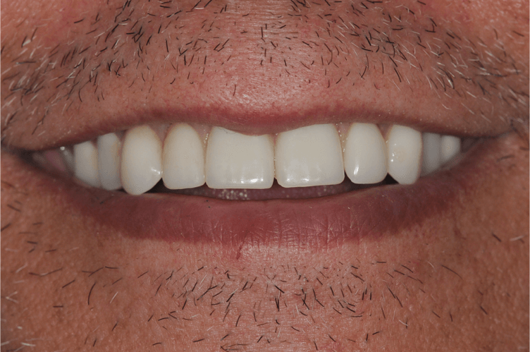 Full Smile After