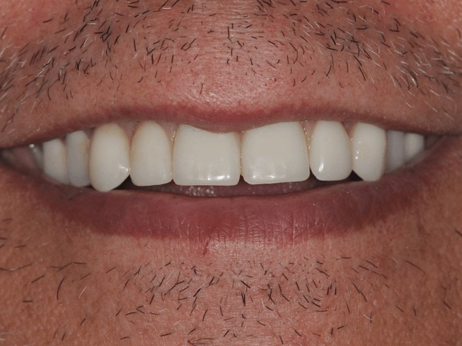 Full Smile After