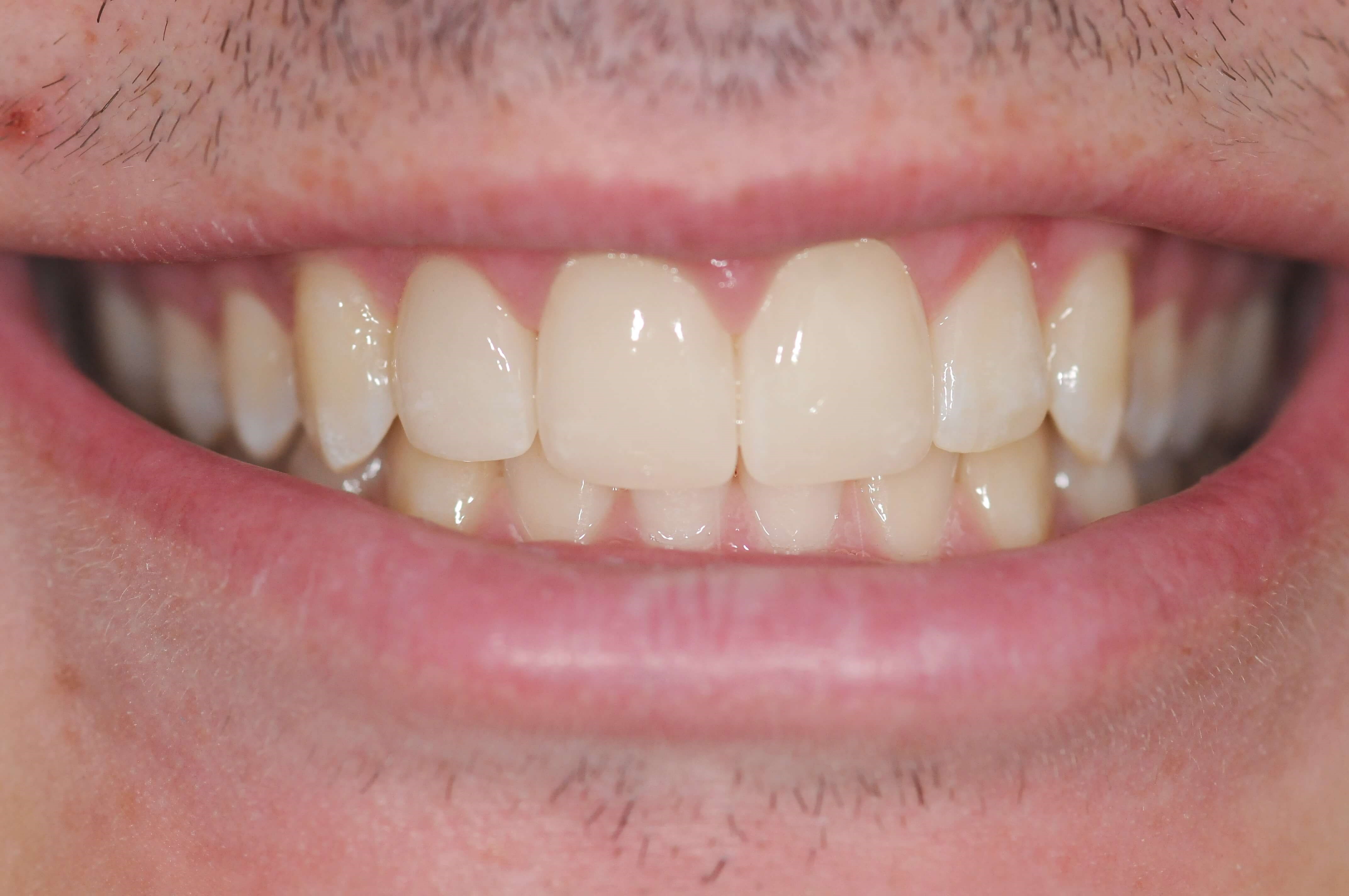 Final Results After - Full Smile