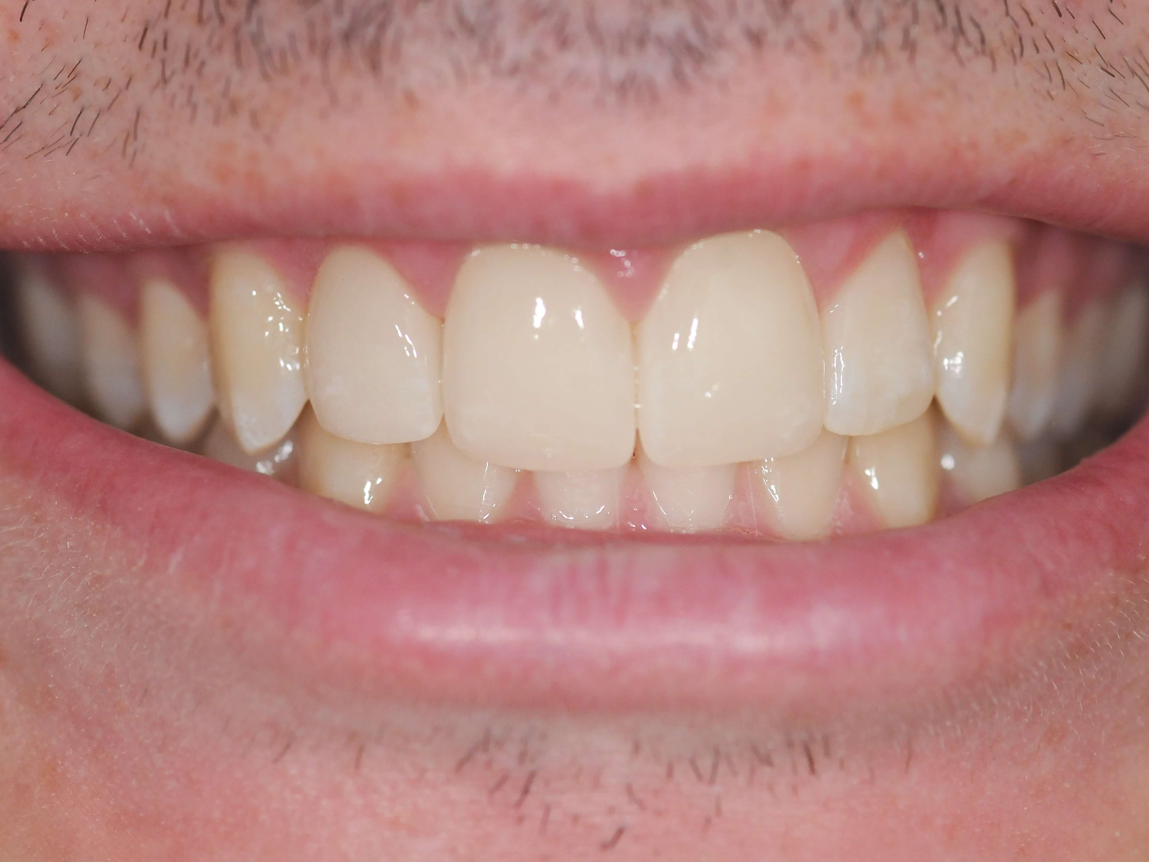 Final Results After - Full Smile