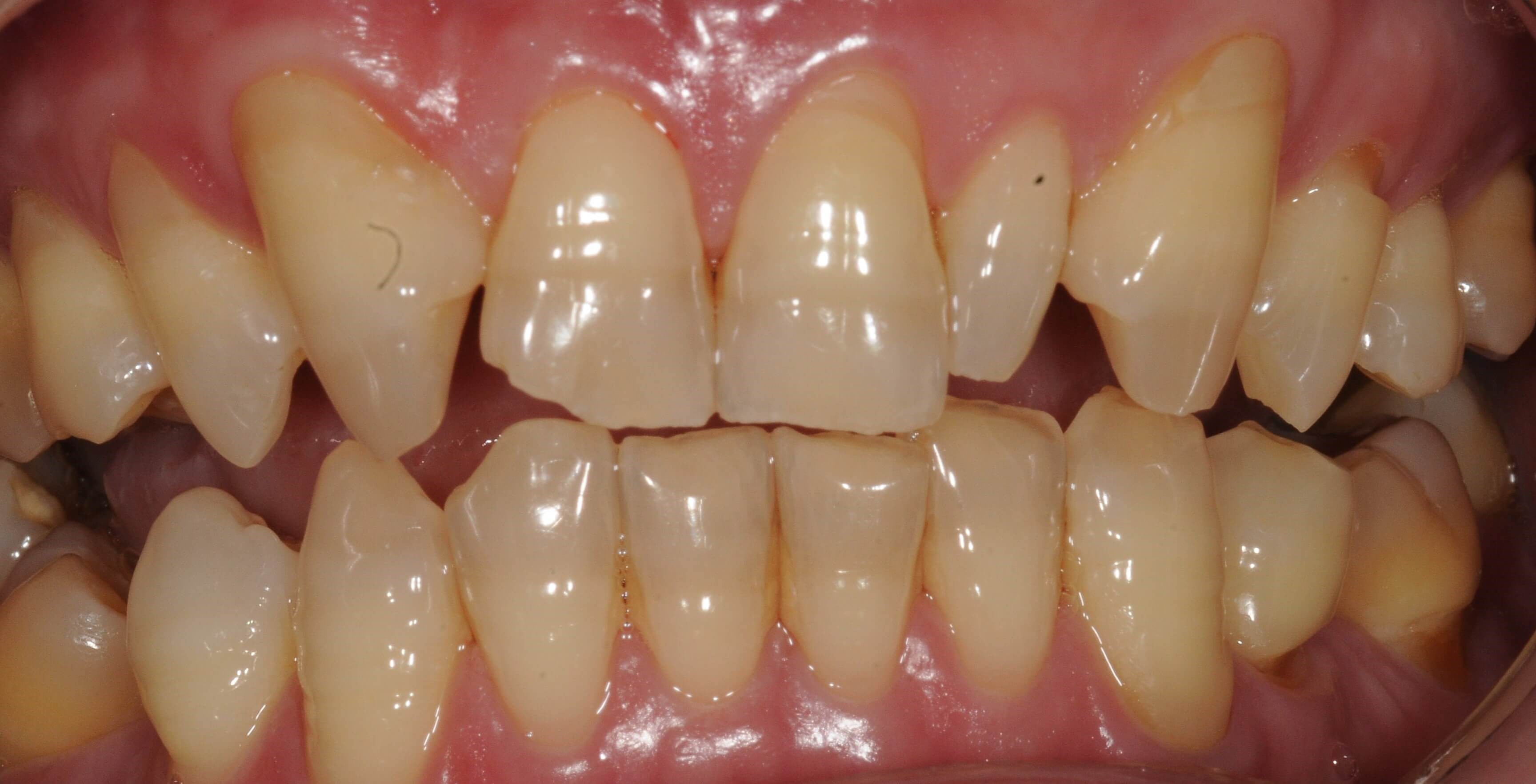 Retracted Smile Before