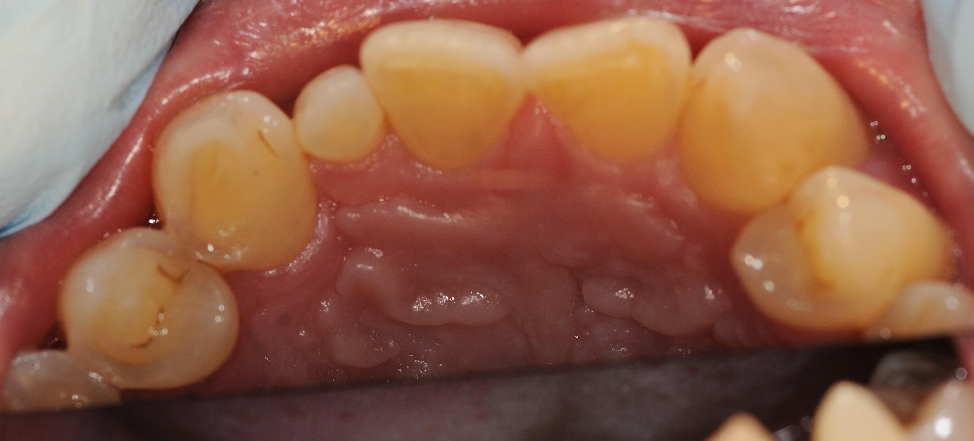 Occlusal view Before