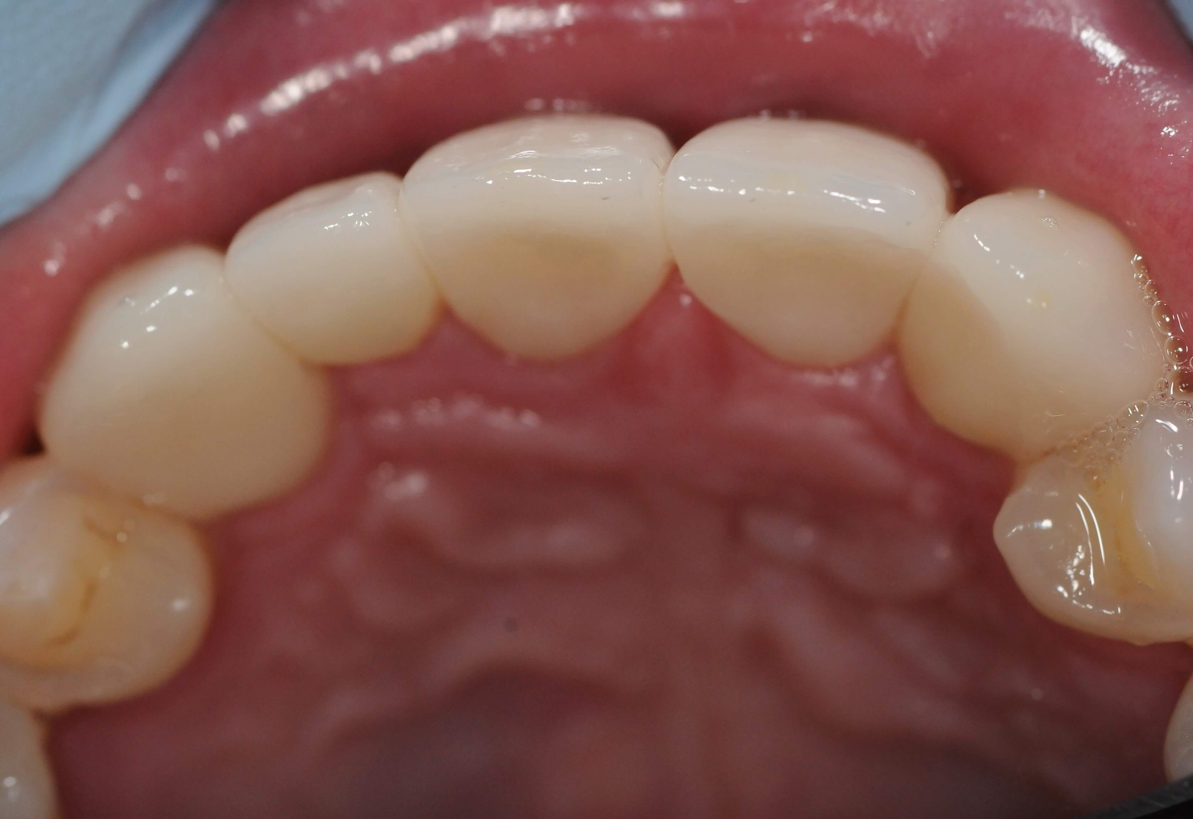 Occlusal view After