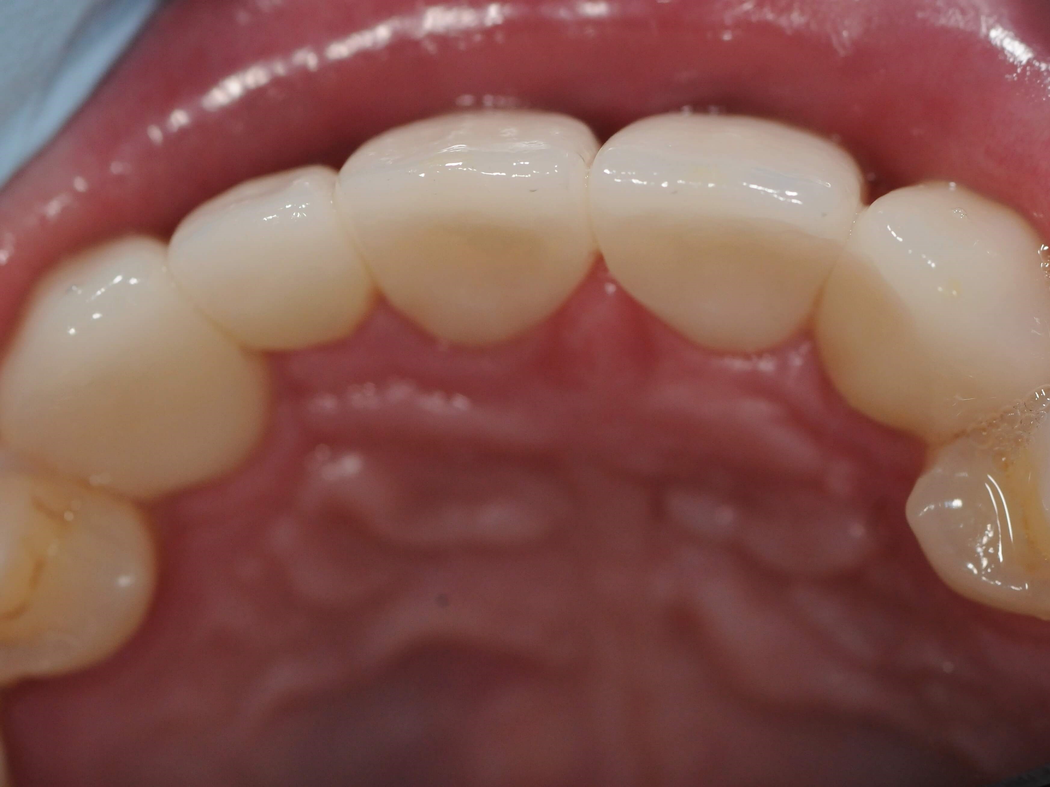 Occlusal view After