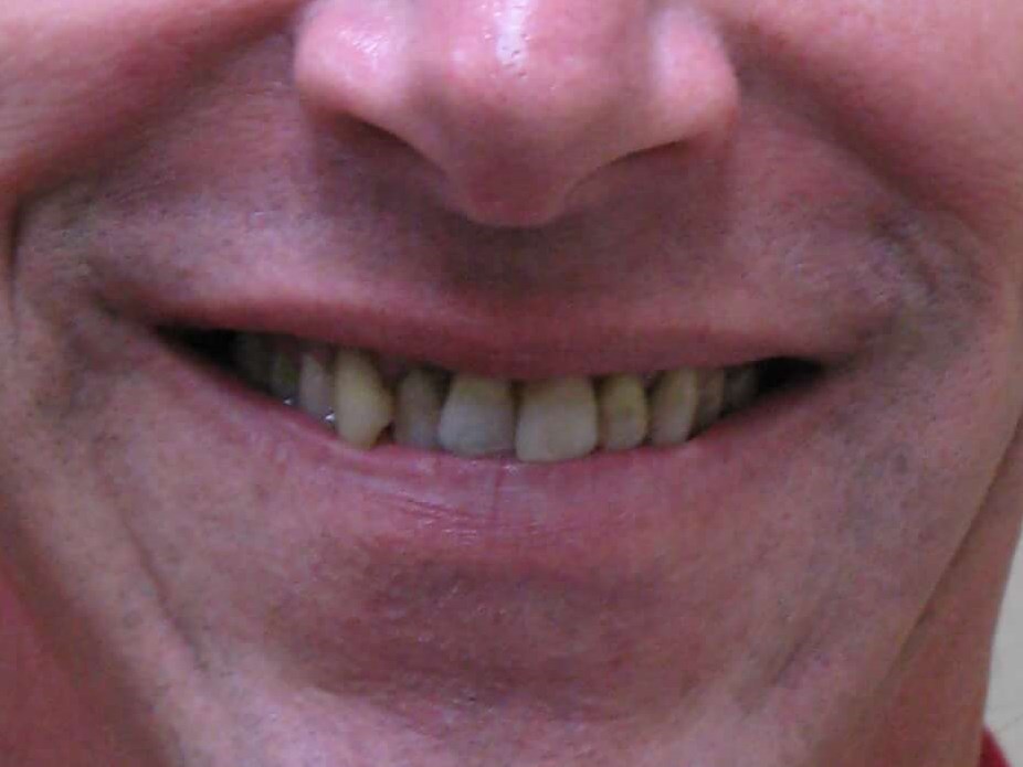 Full Smile Close Up Before