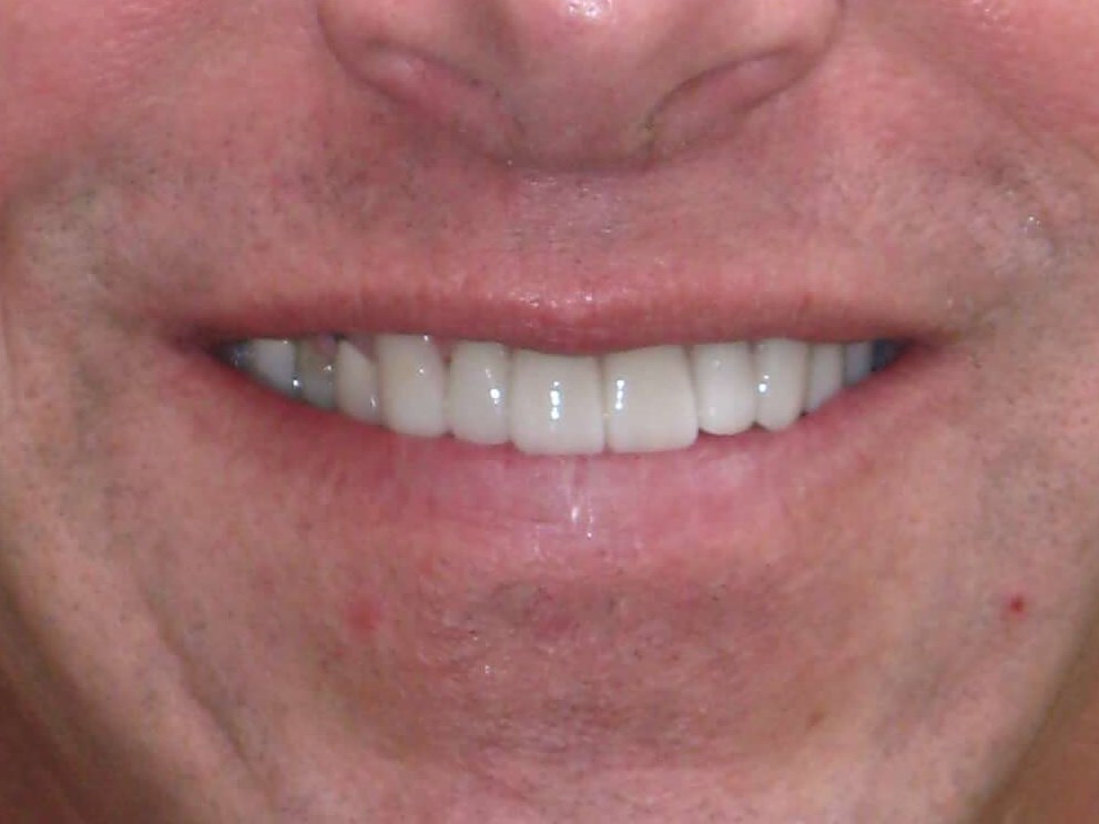 Face View After