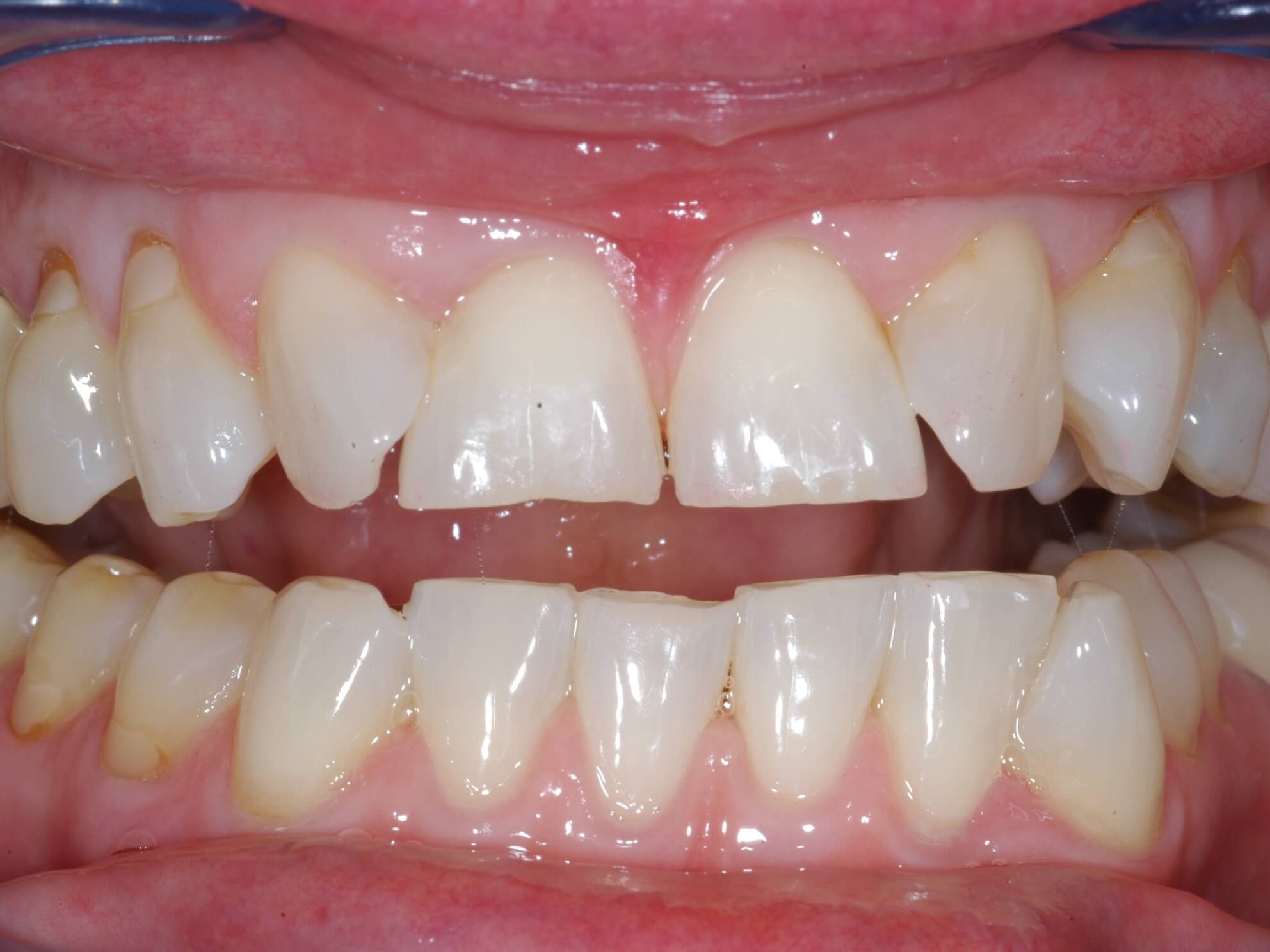 Full View Before