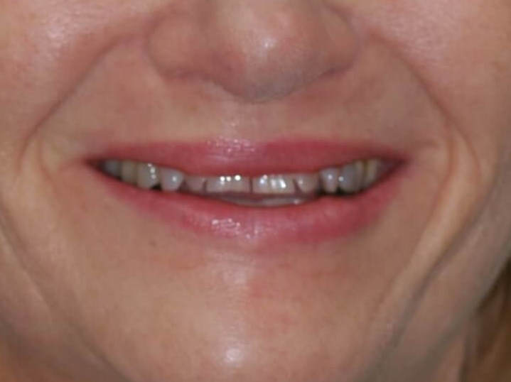 Front view Before