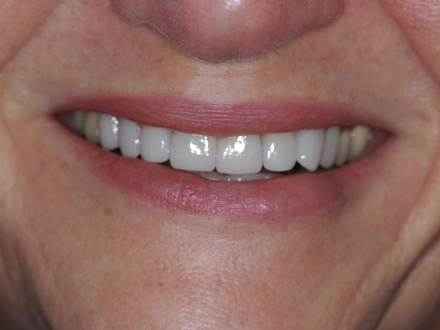 Front view After