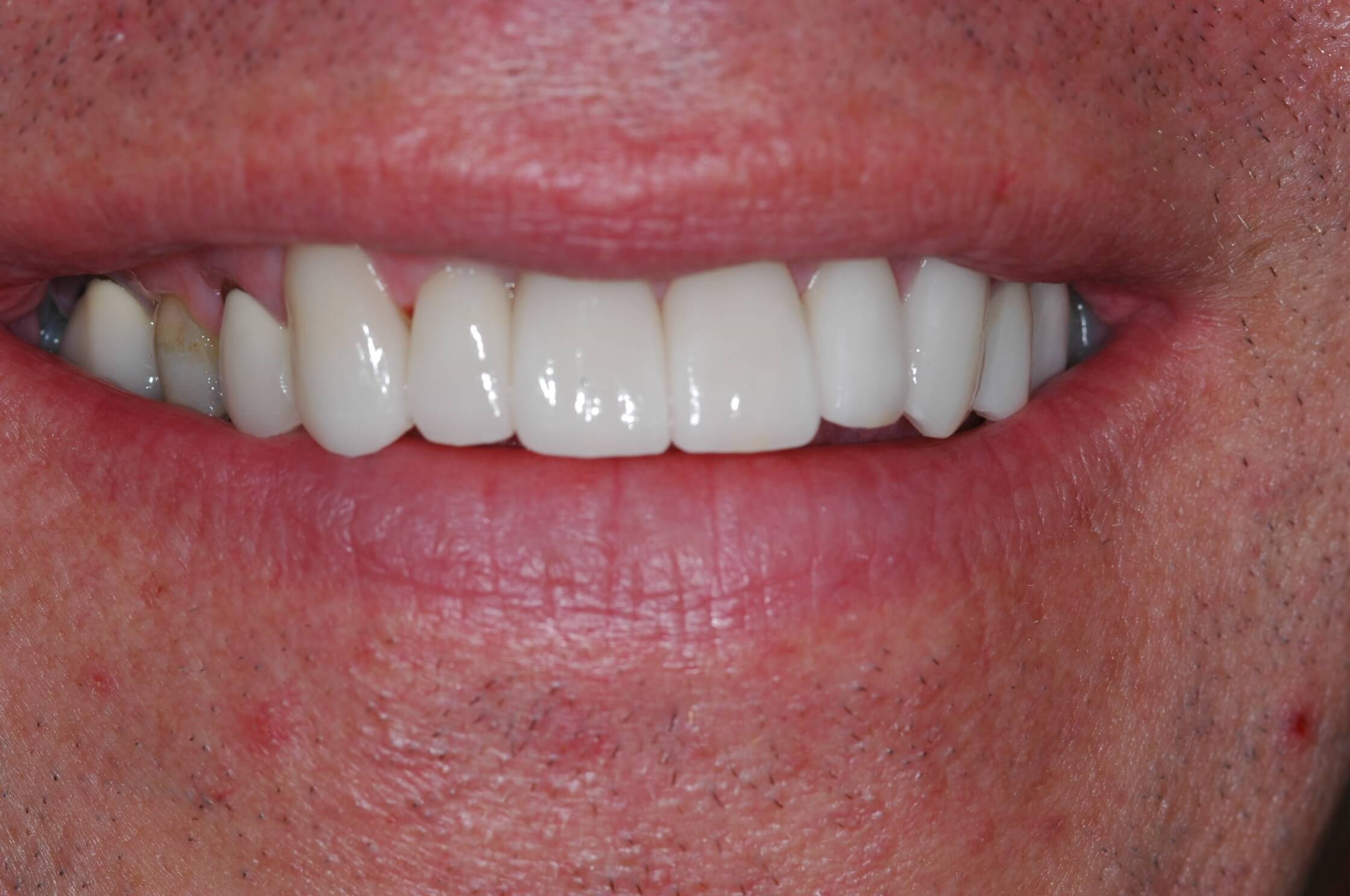 Full Smile Close Up After