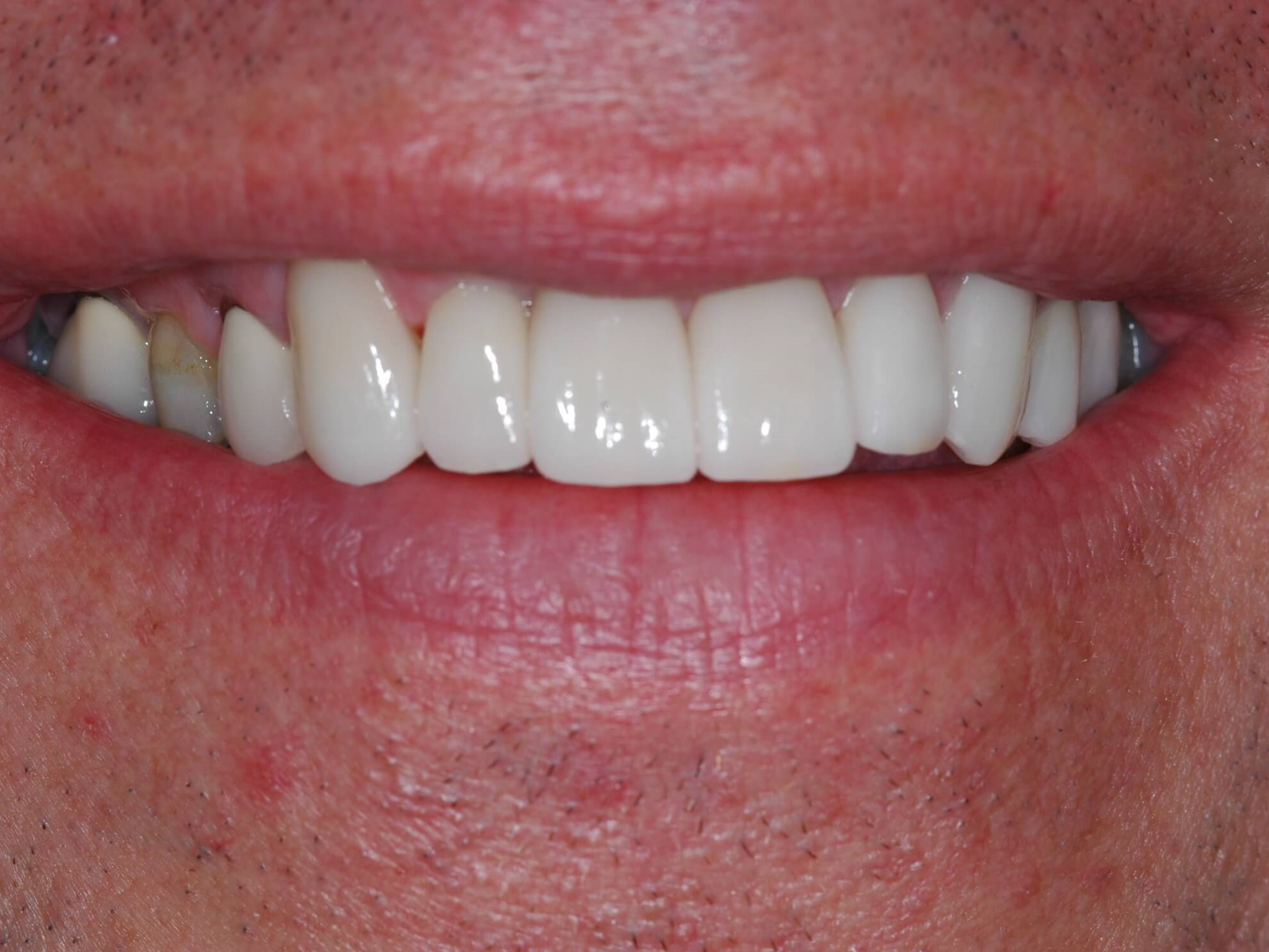 Full Smile Close Up After