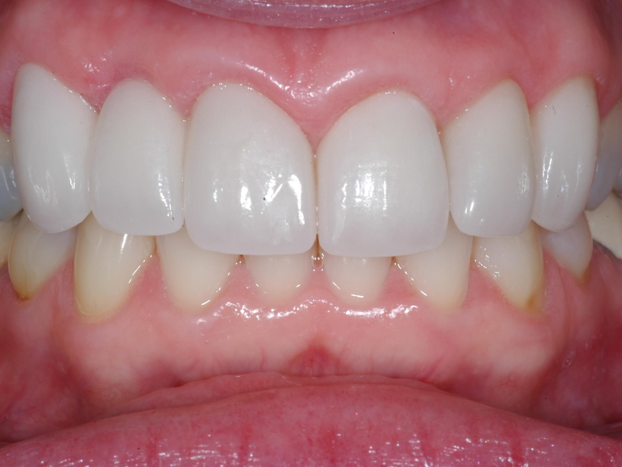 Full Smile After