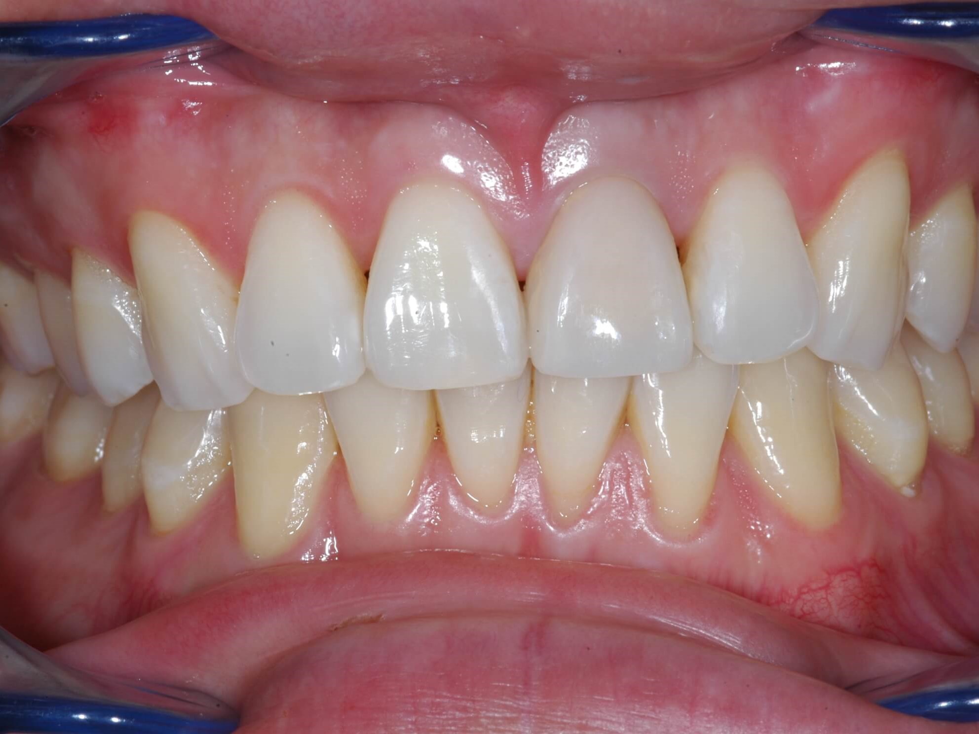 Front View After