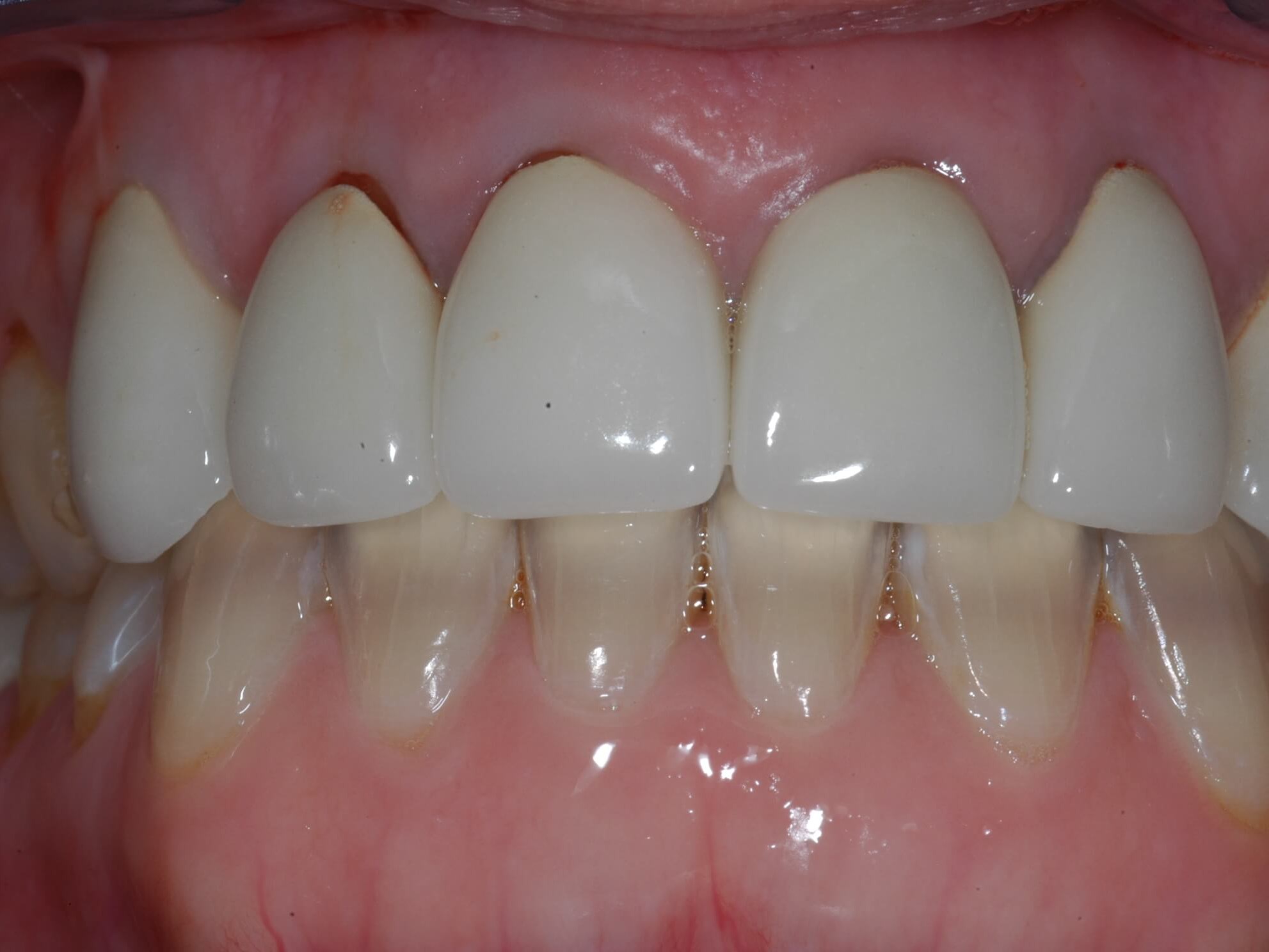All Ceramic Crowns Before
