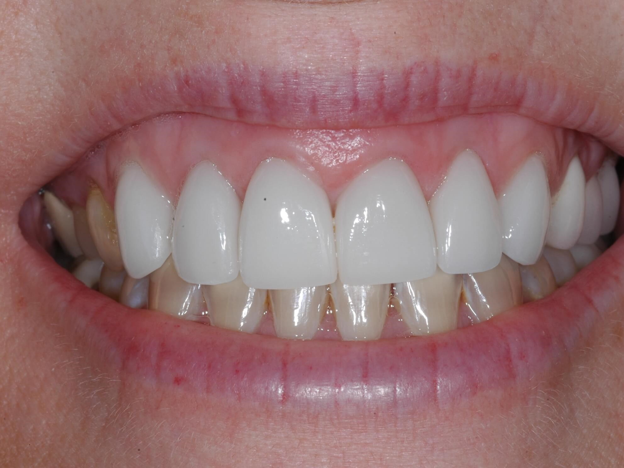 All Ceramic Crowns After