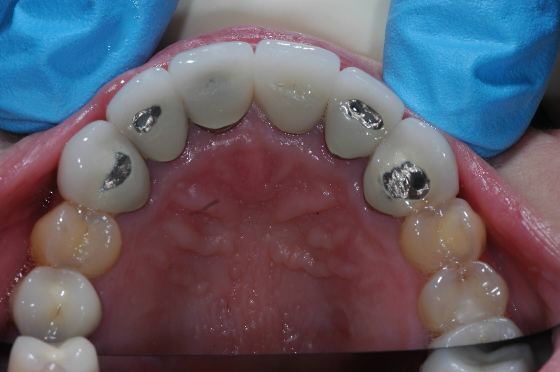 Back side of crowns Before