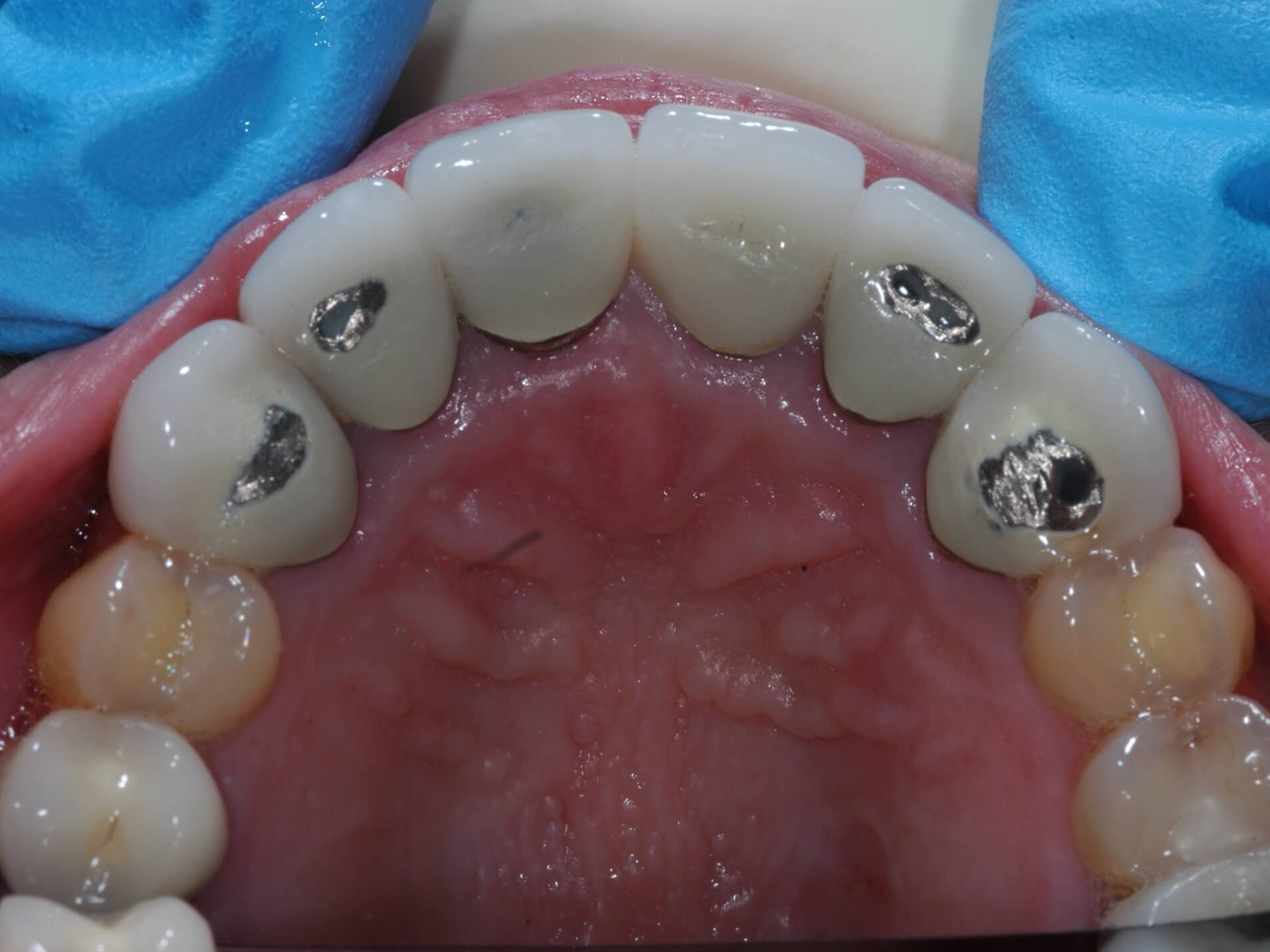 Back side of crowns Before