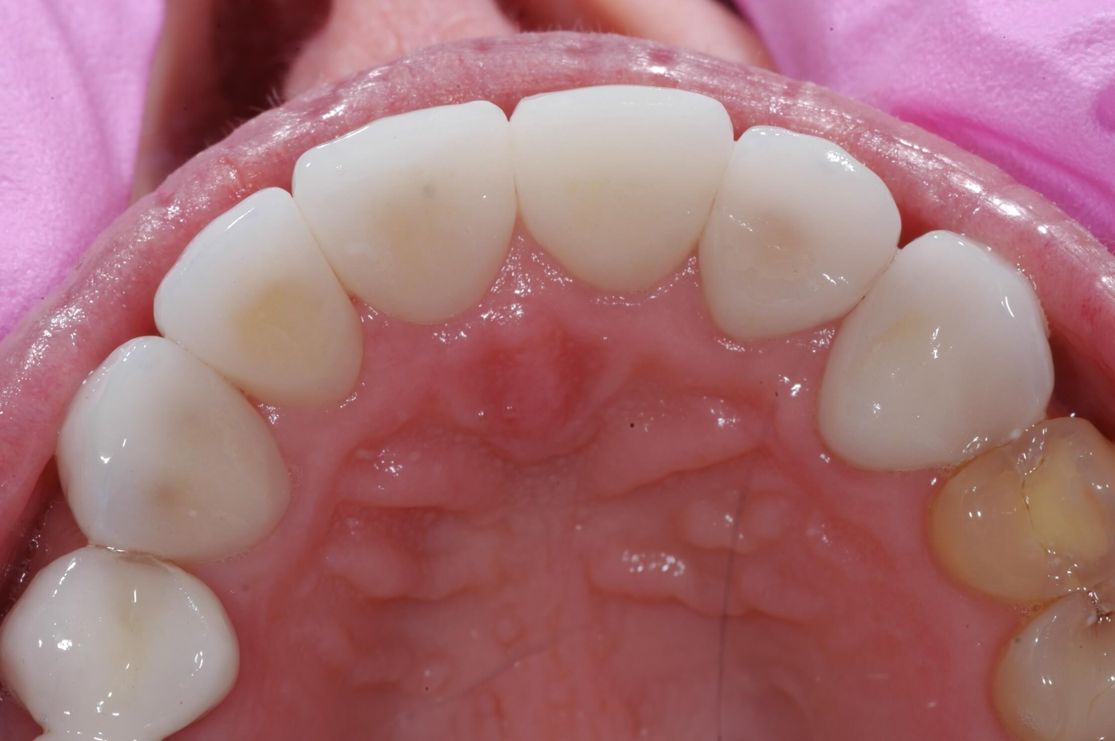 Back side of crowns After