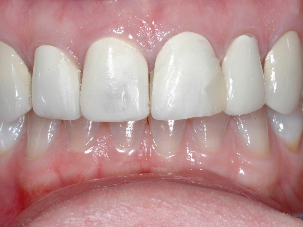 PorcelainVeneers Before