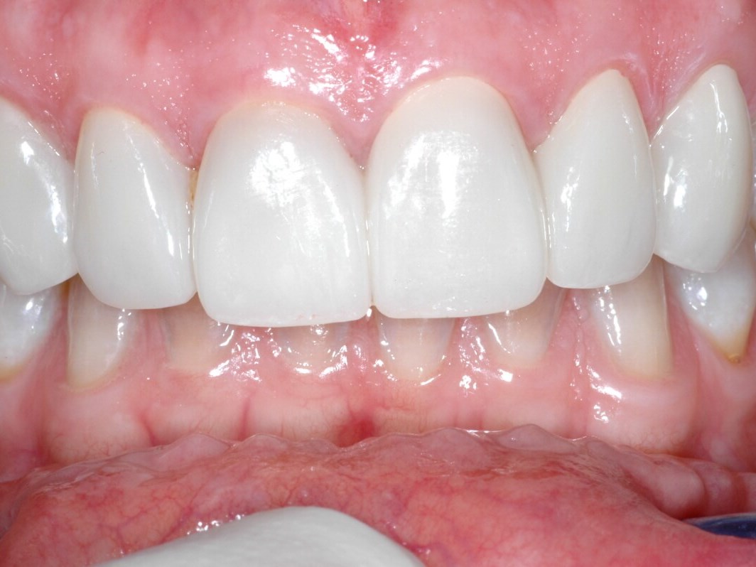 PorcelainVeneers After