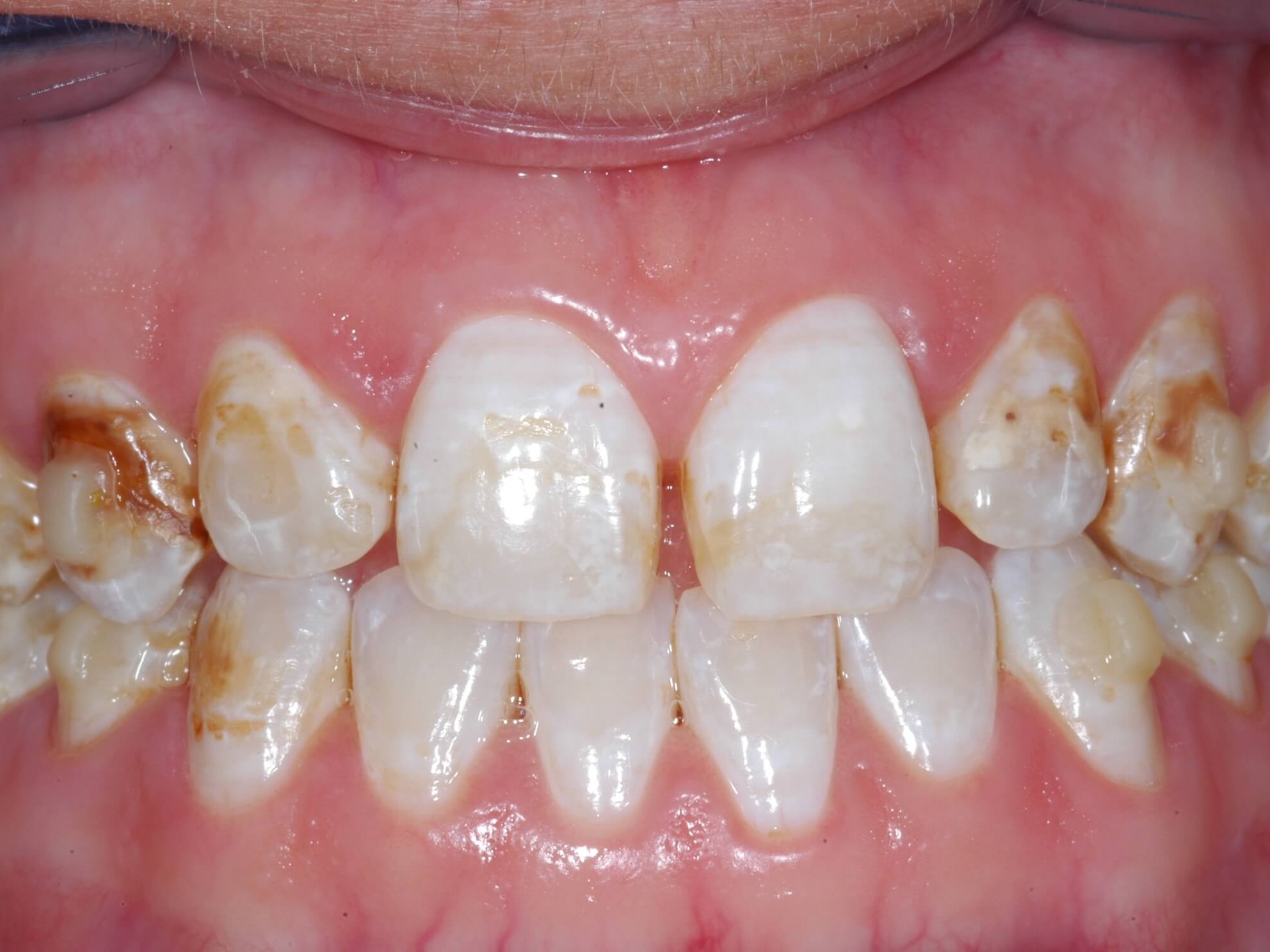 Congenitally Defective Teeth Before