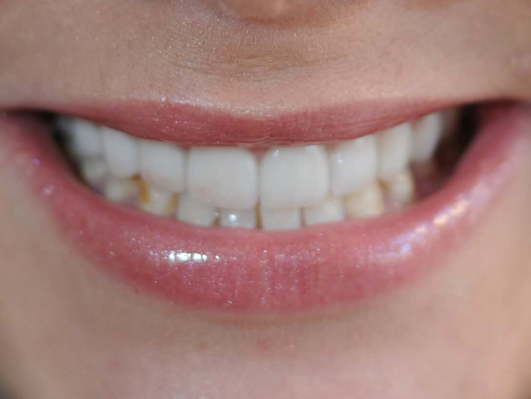 Congenitally Defective Teeth After