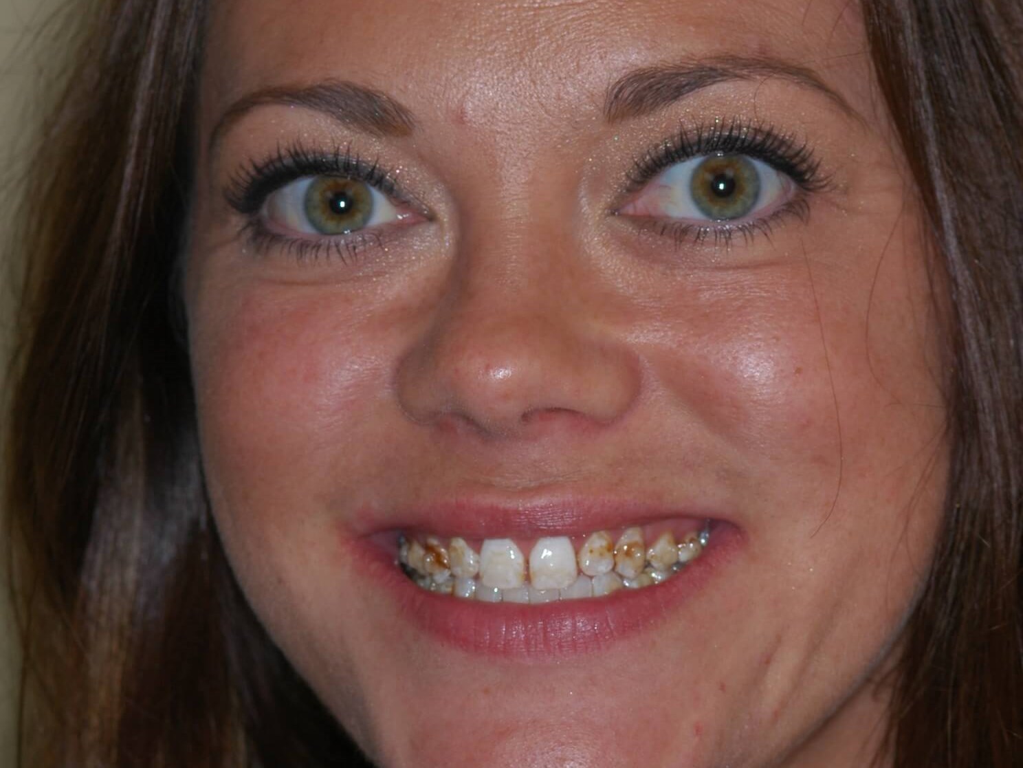 Full Smile Before