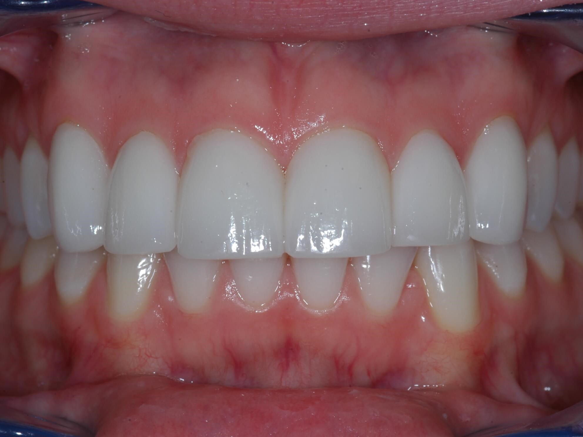 Retracted Smile Before