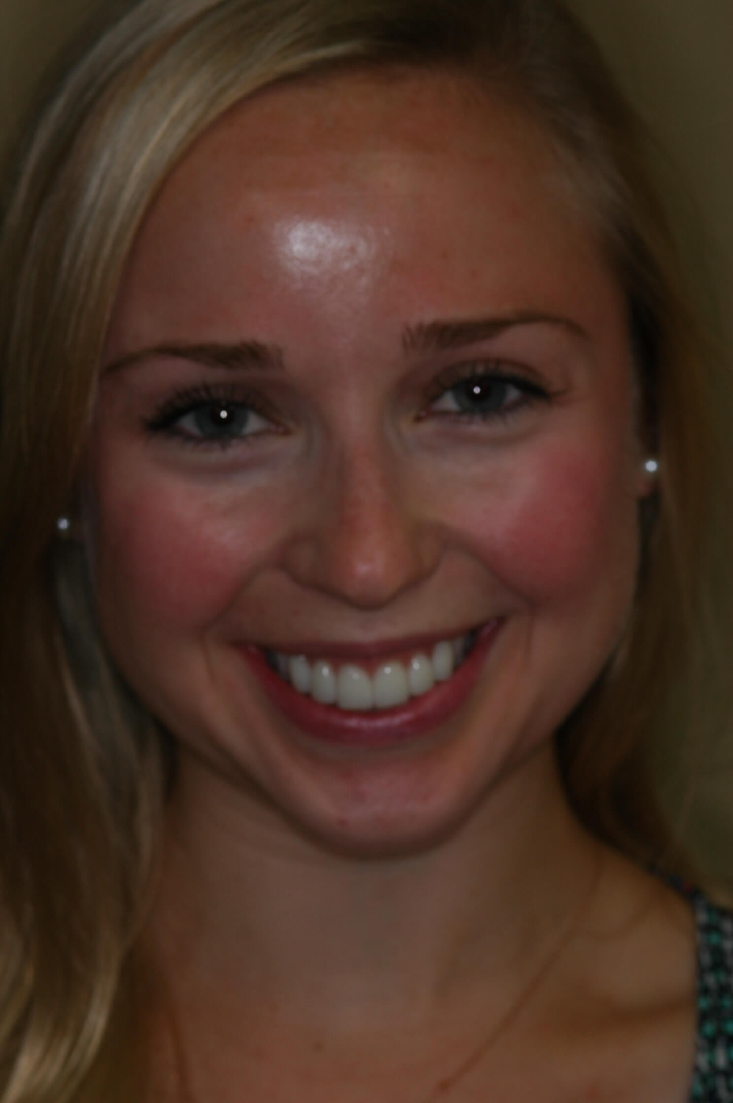 Full Smile Before