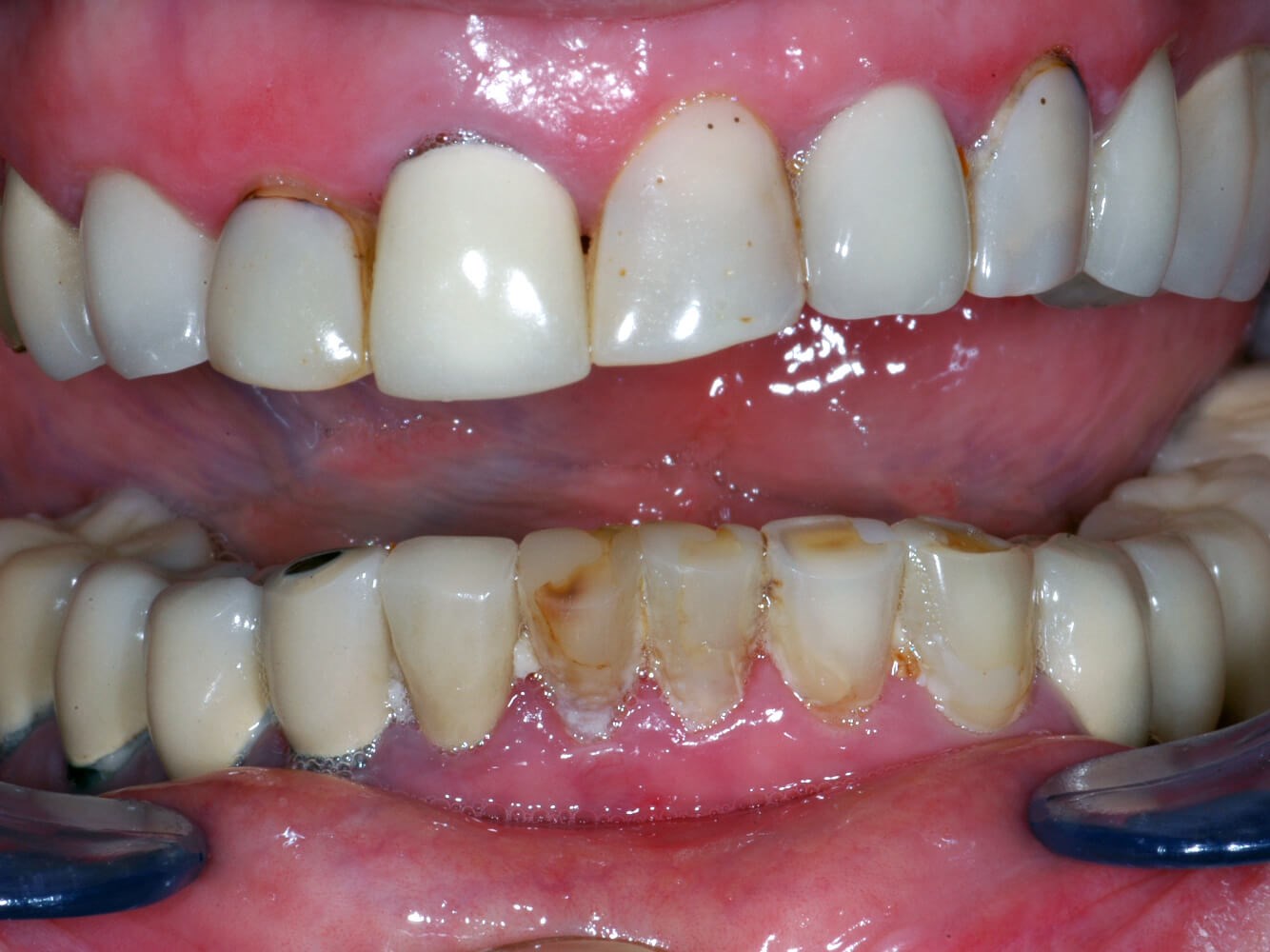 Retracted photo Before