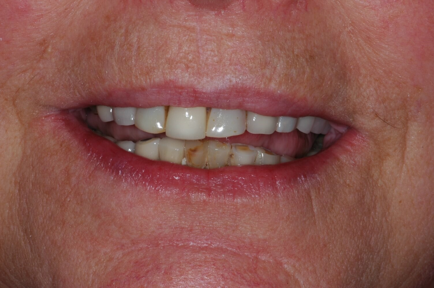 Full Smile Before