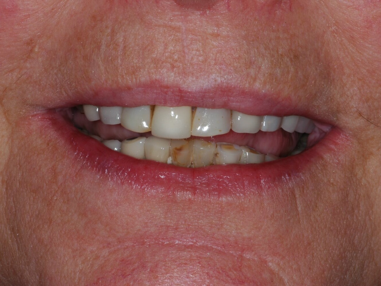 Full Smile Before