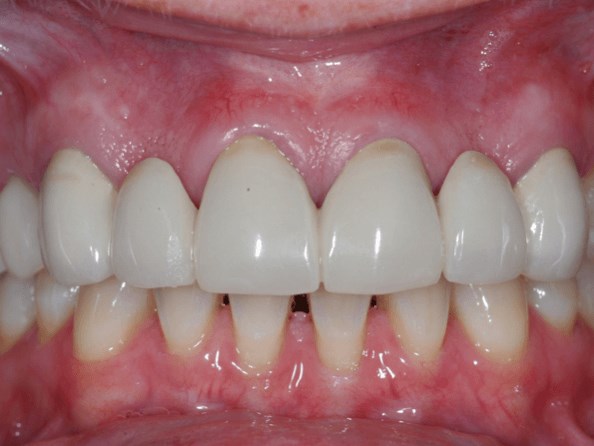 Bright New Smile Before