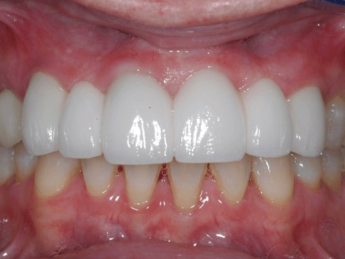 Bright New Smile After