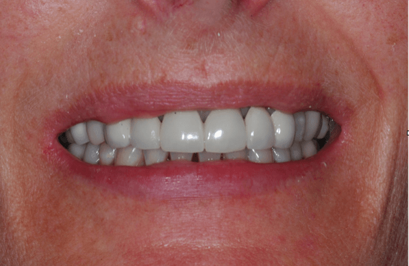 Full smile Before