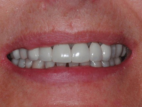 Full smile Before