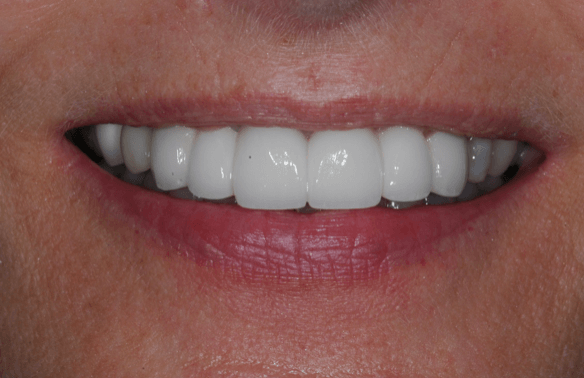 Full smile After