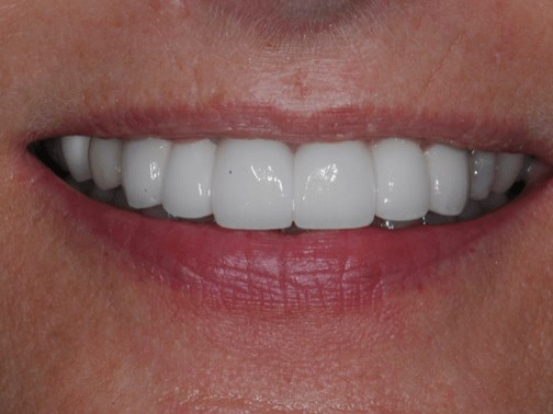 Full smile After