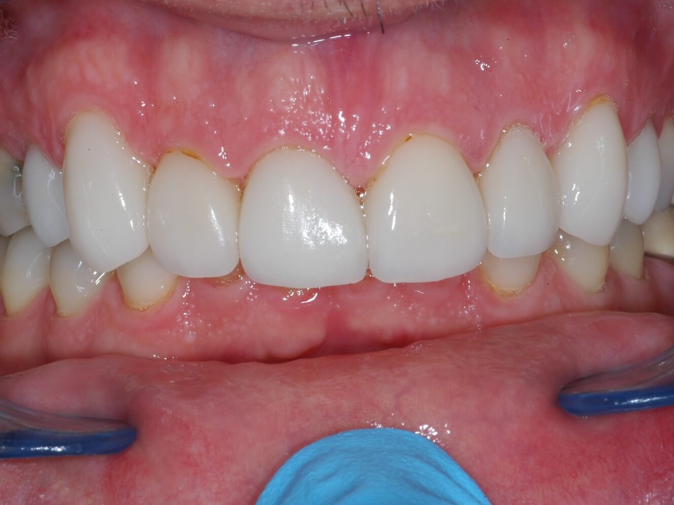 Results Before