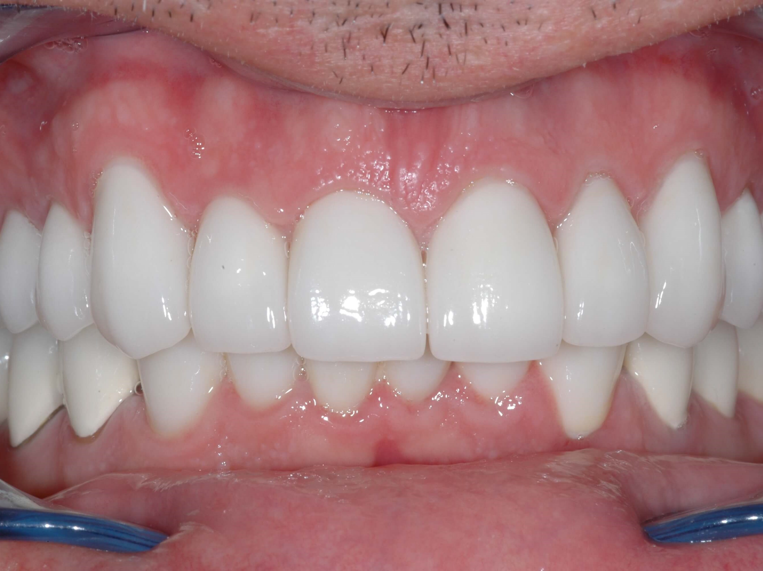 Results After
