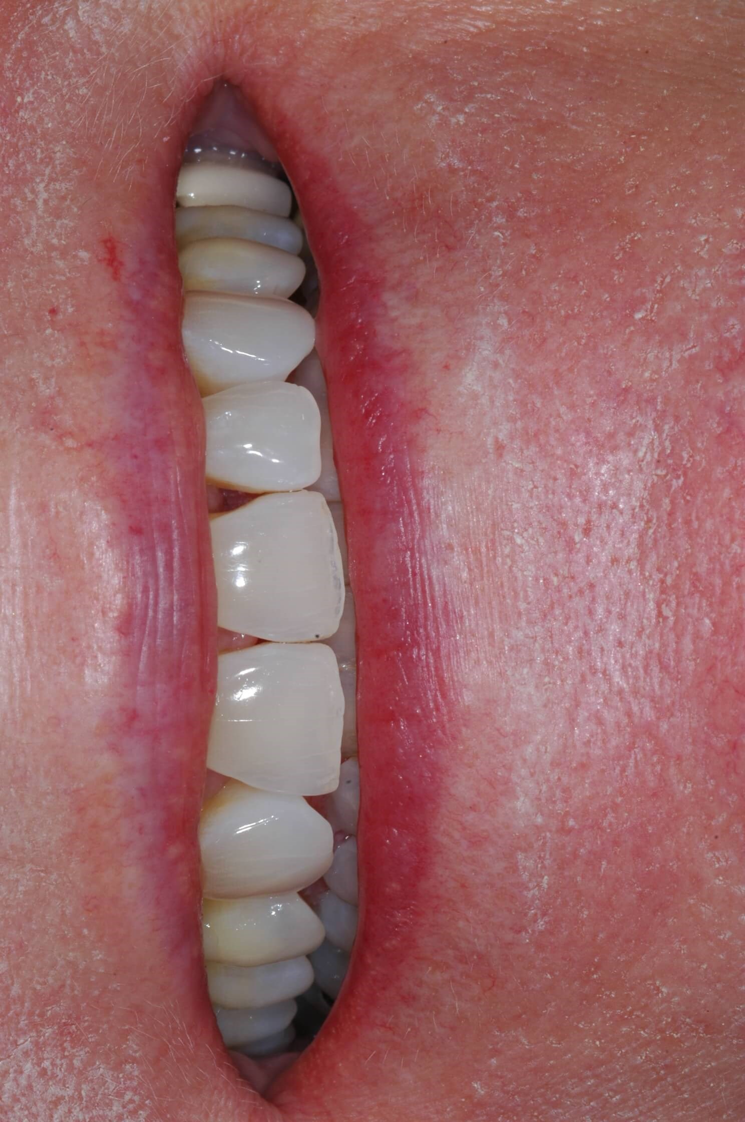 Full smile Before
