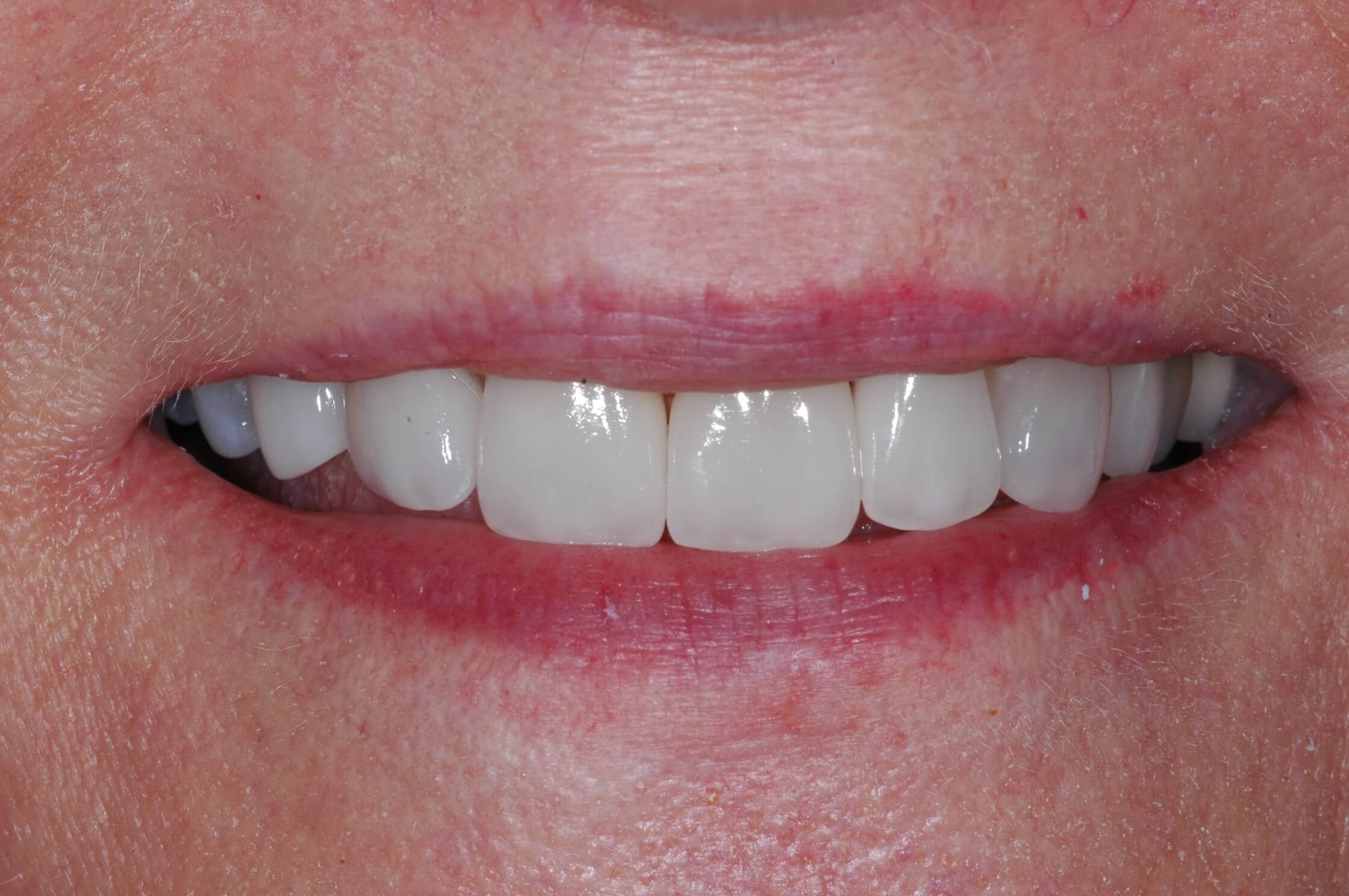 Full smile After