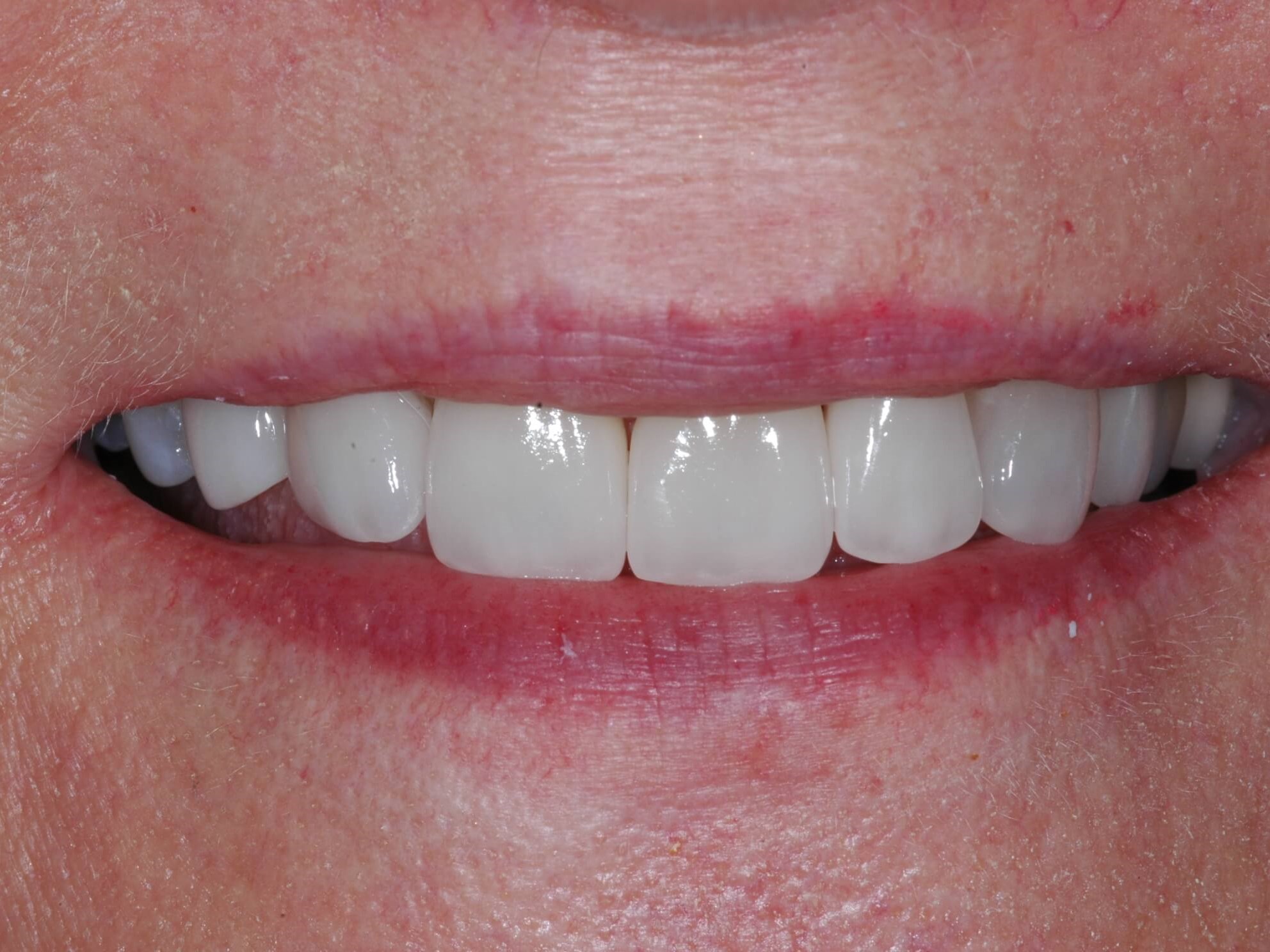 Full smile After