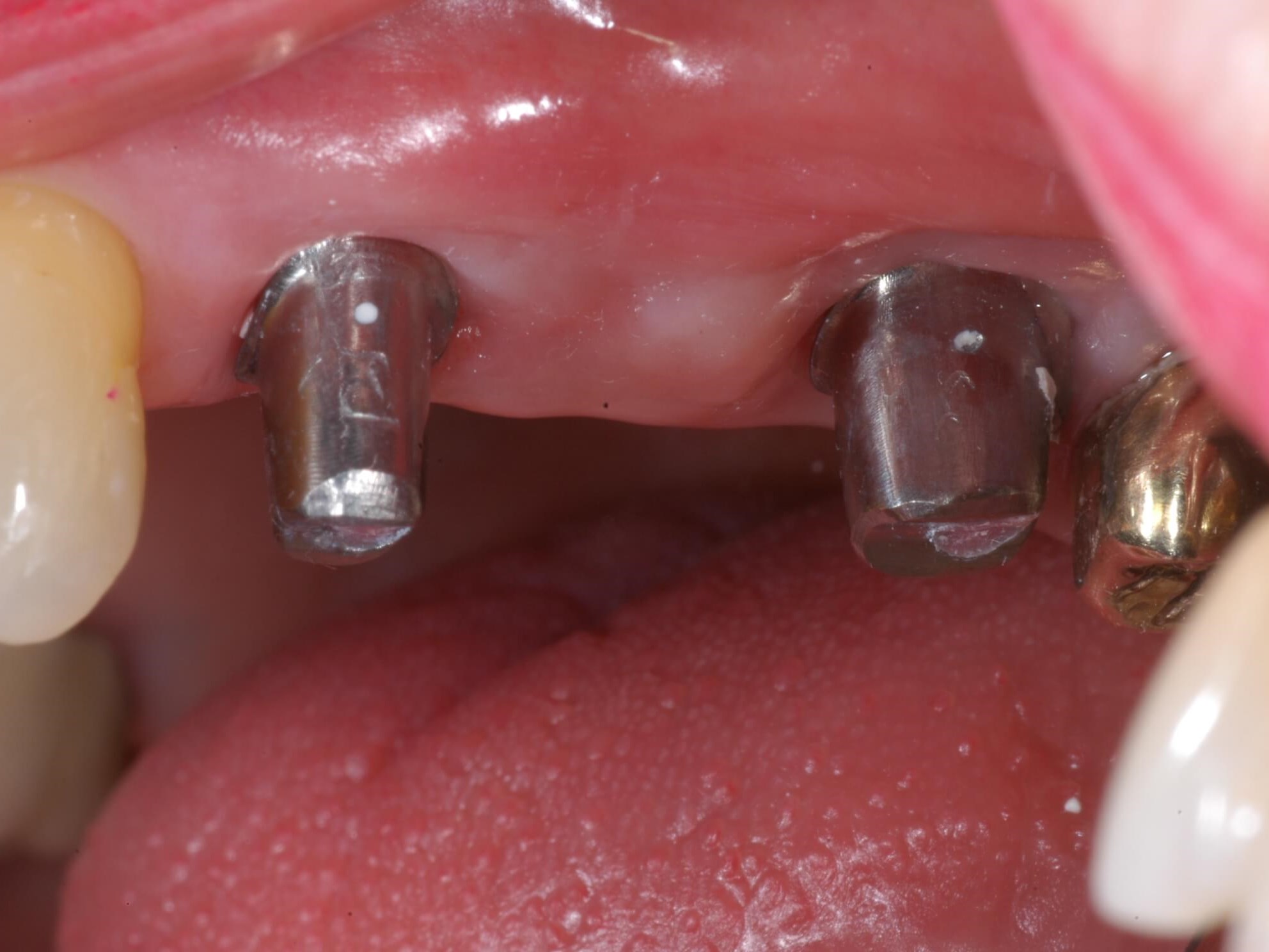 Implant Supported Bridge Implants