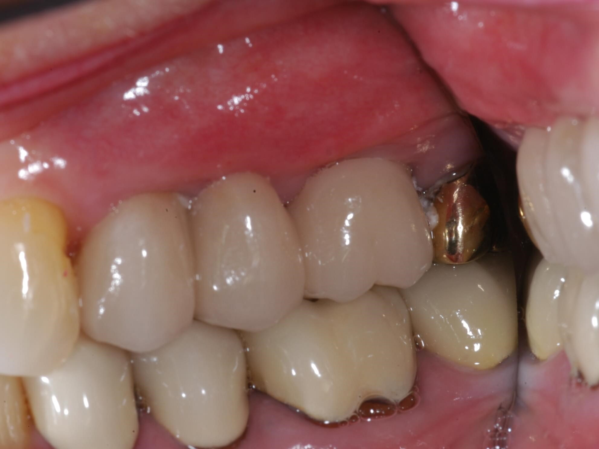 Implant Supported Bridge Bridge