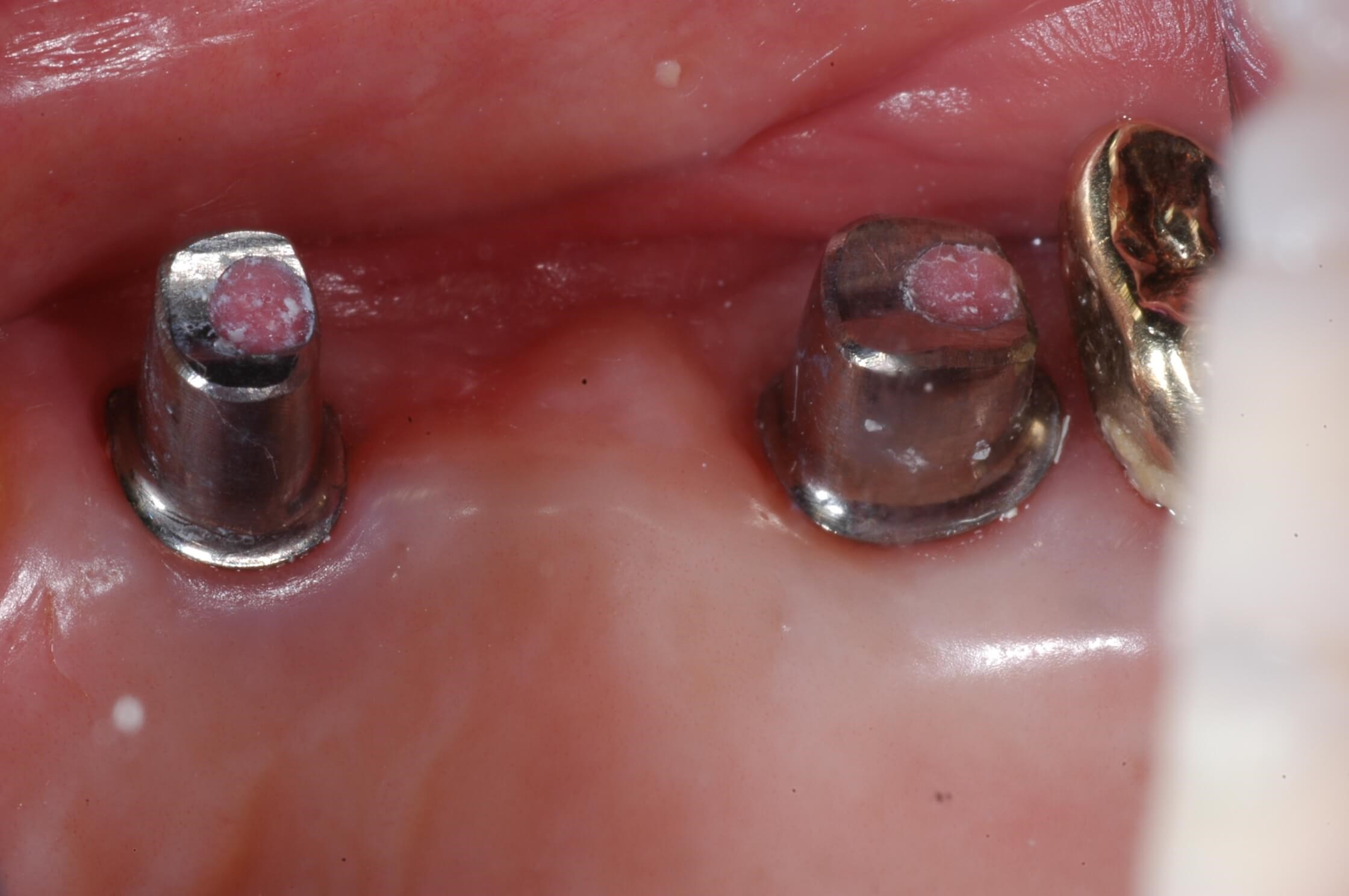 Different view Implants