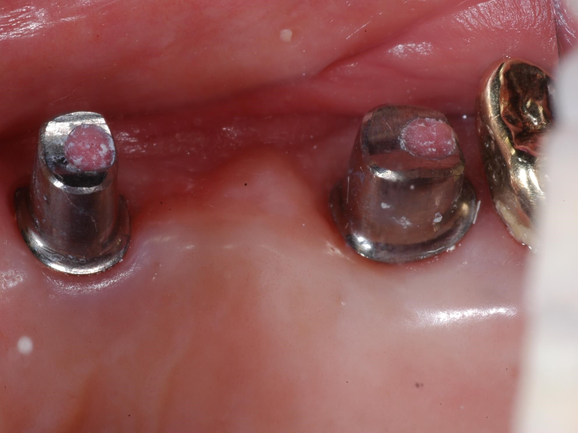 Different view Implants