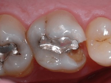 Porcelain Onlay Before