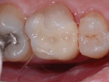 Porcelain Onlay After