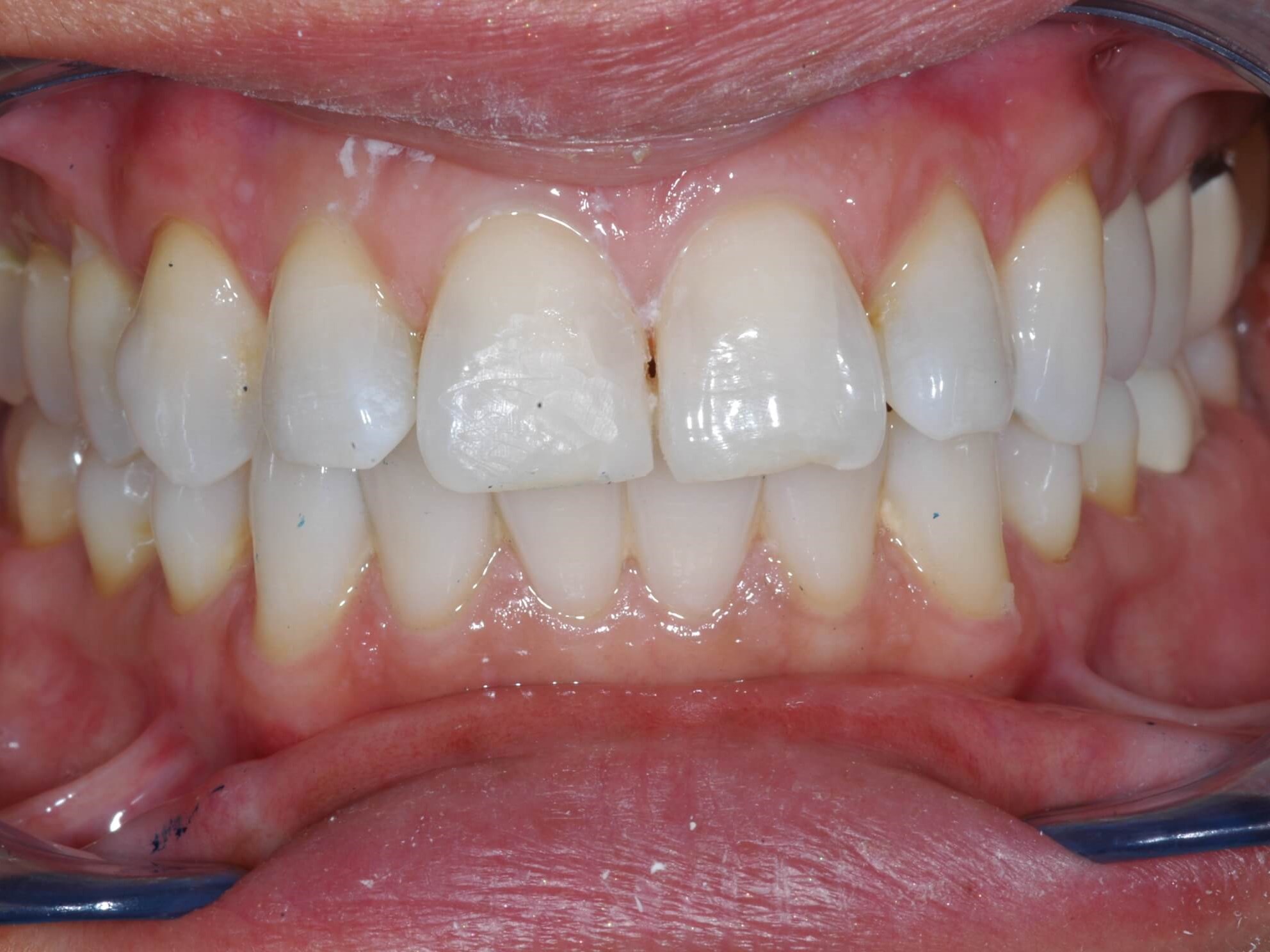Retracted smile Before